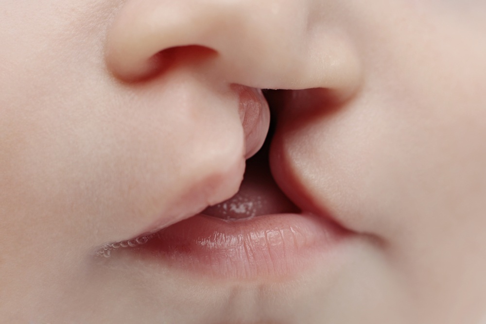 Bebê com lábio fissurado (lábio leporino) - foto: malost/ShutterStock.com