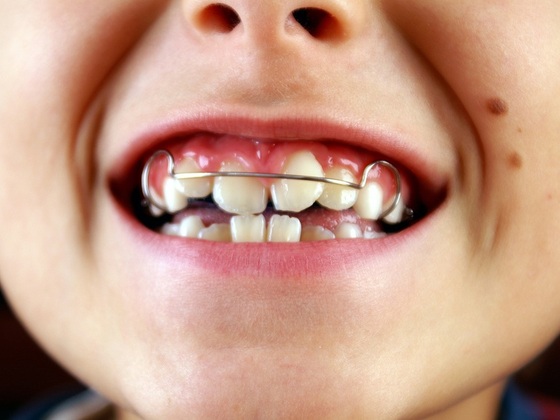 Criança sorrindo e mostrando o aparelho ortodôntico preso aos dentes - Foto: Nessli Orpmas/Shutterstock.com