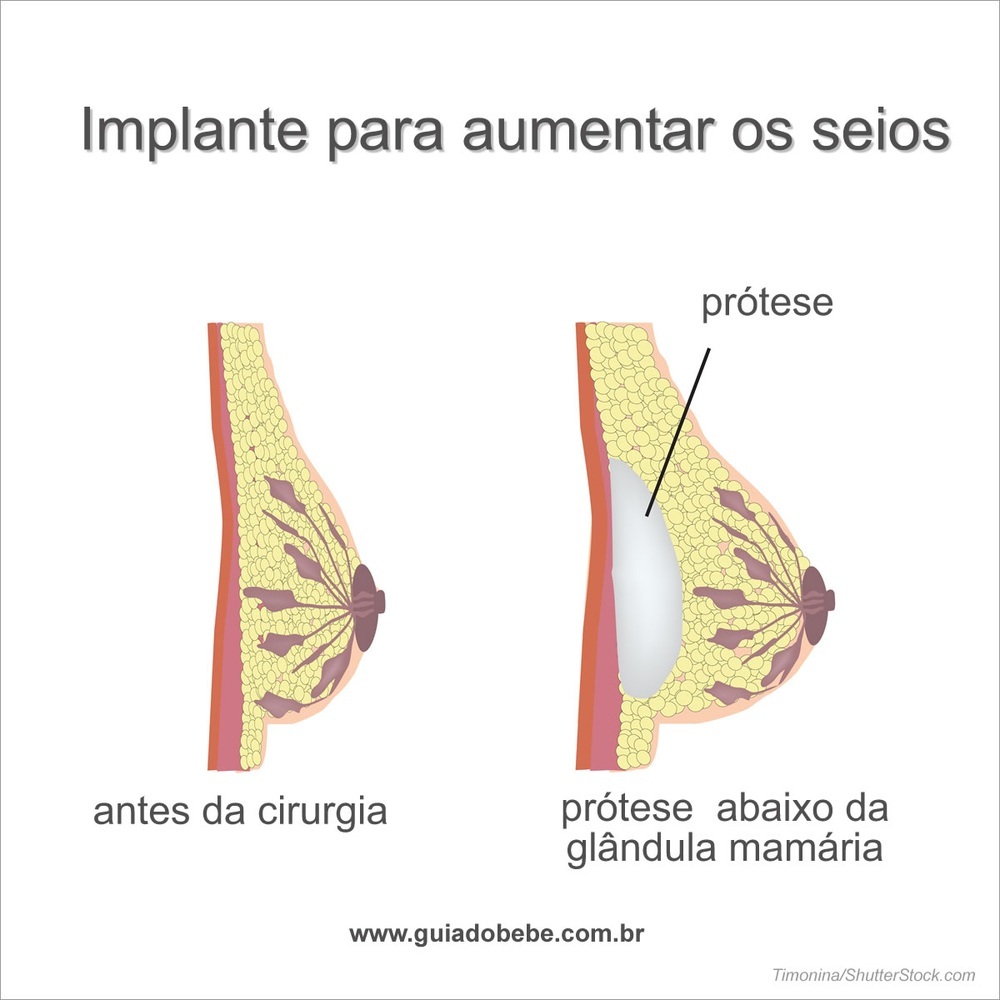 Ilustração mostrando o antes e o depois da cirurgia de implante de prótese de silicone - foto: Timonina/ShutterStock.com